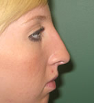 Otoplasty | Rhinoplasty | Blepharoplasty | Rhytidectomy | Browlift | Earlobe Repair