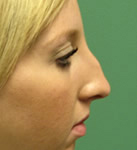 Otoplasty | Rhinoplasty | Blepharoplasty | Rhytidectomy | Browlift | Earlobe Repair